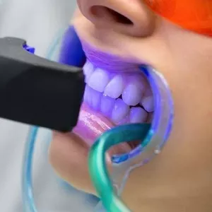 Салон отбеливания зубов